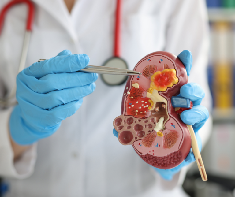 Understanding Kidney Stones: How to Recognize, Prevent, and Manage Them